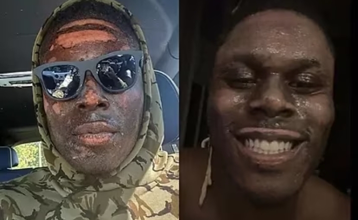 David Njoku reveals how the accident that burned his face happened: I ended up exploding